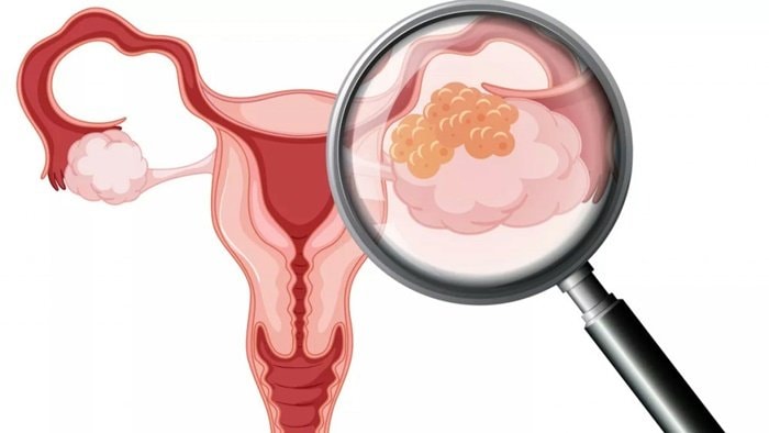 Bontang Gratiskan Pap Smear dan Imunisasi HPV, tapi Masih Banyak Perempuan Malu Periksa