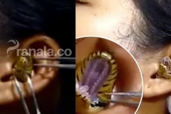 Bikin Ngeri, Ular Berbisa Bersarang di Telinga Wanita Ini